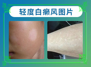 [有哪些方法可以緩解]白殿風長在臉上好治嗎