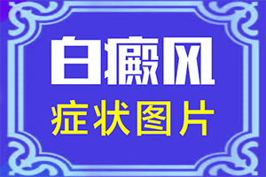 白顛瘋主要是怎么引起的-兩歲的寶寶臉上有白斑怎么回事