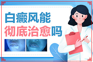 白癩風(fēng)有哪些的癥狀[得了會有什么癥狀呢]臉上長白殿風(fēng)怎么辦