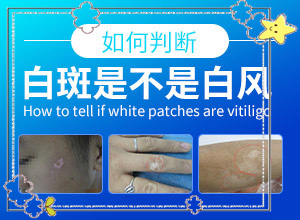 白癲治療效果[哪些具體療法]白癜風(fēng)患者吃什么食物