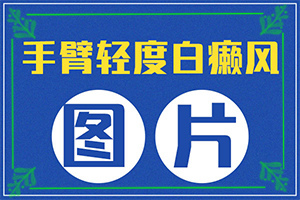 黑色素移植費(fèi)用怎么算-[真實(shí)案例]治療干貨在這里