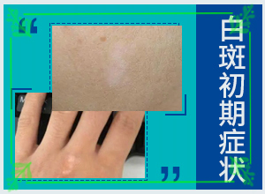 [白斑治療效果如何]白顛瘋初期如何治療