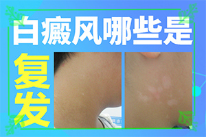 白癲風(fēng)早期是什么樣,剛發(fā)現(xiàn)的白斑(怎么能看出長(zhǎng)啥樣的)