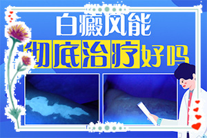 [醫(yī)治白斑有什么竅門]哪個(gè)治療白癲好