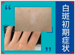 白點癲風長什么樣子,如何診斷正確的呢(如何辨別)