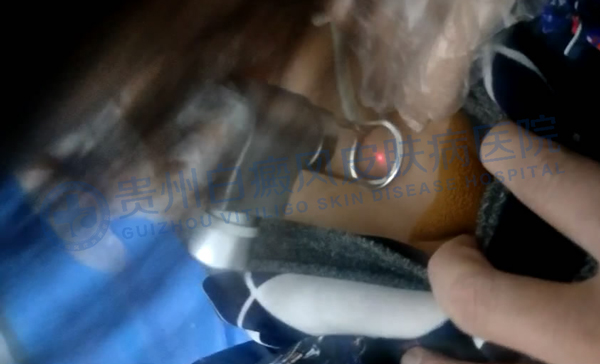 二氧化碳激光治療機(jī)治療