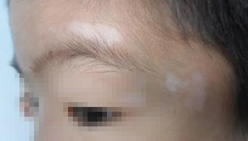 小孩身上有白斑怎么辦？