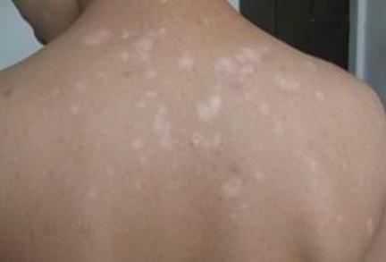 白癜風(fēng)初期癥狀表現(xiàn)