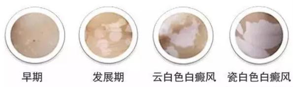 白癜風(fēng)顏色