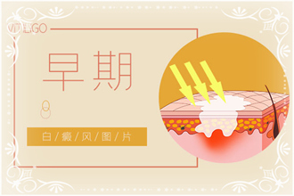 白點(diǎn)風(fēng)病情發(fā)作后白斑癥狀，你了解了嗎