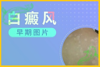 小孩子身上白斑是不是白癩風(fēng)癥狀初期