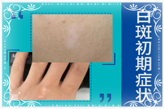 惠水縣白點(diǎn)風(fēng)不能吃什么-多吃什么-科學(xué)的飲食有益病情恢復(fù)