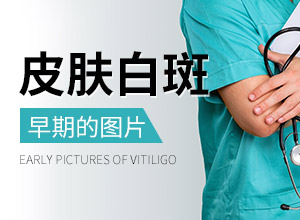 【】魯索替尼治療白癜風(fēng)使用有哪些