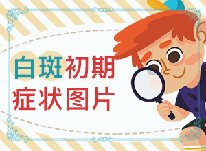 寶寶四歲臉上有白斑是怎么回事,有什么因素呢(具體誘因致使白斑)