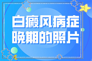 小孩入秋臉上長白斑是怎么回事,得白癜風的概率(何種原因呢)