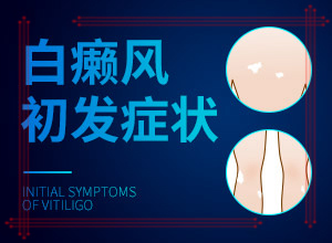 治療白癲瘋醫(yī)院[如何診斷和治療]手上長(zhǎng)白斑用什么藥擦好