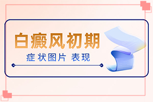 白點癲風(fēng)的初期如何冶[如何進行治療]兒童白顛瘋病可以治愈嗎