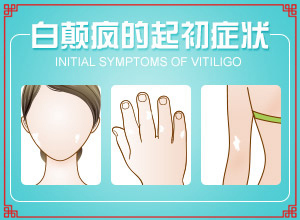 白殿病是可以治愈嗎[如何更好地治療]白顛瘋怎么治