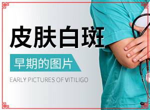 臉上一大塊白斑怎么回事[前期癥狀怎樣]白癲瘋早期癥狀
