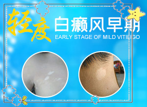 [用什么方法治]兒童白點癲風(fēng)可以治好嗎