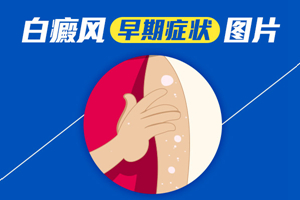 [速度看]早期白癜風(fēng)的癥狀是什么樣子的-我們可以通過什么判斷識別早期的白癜風(fēng)