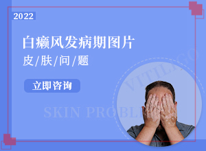 20多年的白斑了沒有擴(kuò)散 可以怎么治（怎么治療比較好）