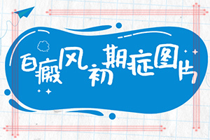 [哪些診療方式可取]白癩風能治嗎