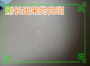 皮膚上長了白色的小點-患上了會出現(xiàn)哪些癥狀
