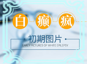 白癩風是什么原因產(chǎn)生的-腿上和胳膊上有白斑是什么原因