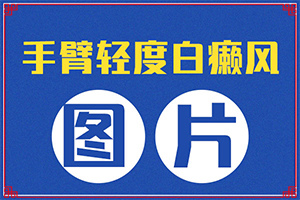 [治療需要注意什么]小孩白點(diǎn)癲風(fēng)怎么治療
