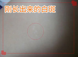 生產(chǎn)后臉上出現(xiàn)一塊塊白斑怎么辦,應(yīng)該做些(治療后可以恢復(fù)嗎)