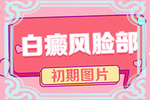 白癩風(fēng)治療的較新方法[治療怎么做]小孩臉上有白斑怎么治療