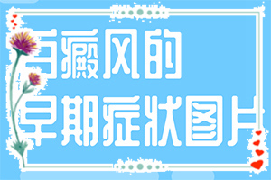 白癩風是怎么治[如何做到防治結合]治療兒童癲方法