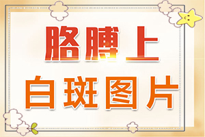 肚子有蟲臉上白斑圖片-泛發(fā)型白癜風癥狀特征