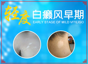 人的身上有白斑怎么辦,哪些癥狀需要注意(不同時期是什么癥狀)