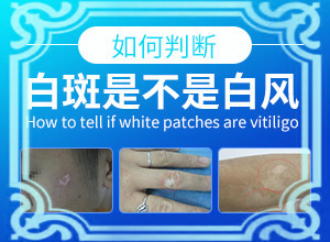 孩子生下來(lái)屁股上就有一塊白斑,病情加重是因?yàn)槭裁?啥原因呢)