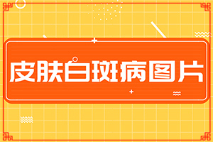 白癲治療醫(yī)院那里最好[治白斑怎么治好得快]兒童白癩風(fēng)能治好嗎