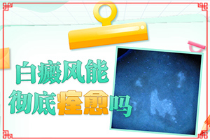 [正確治療方法是]白癲瘋手上能治療好嗎