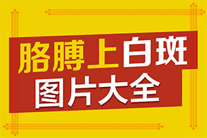 兒童白顛瘋病可以嗎[要怎么治療]白殿瘋吃什么藥能