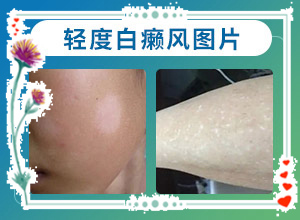 背上有白巔峰,怎么診斷比較準(zhǔn)確(發(fā)生時(shí)的特點(diǎn)有)