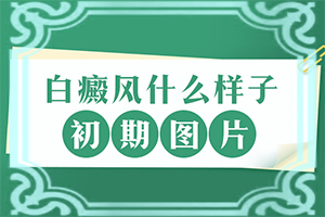 頭皮長了白班[常見診斷方式]白殿風(fēng)的癥狀