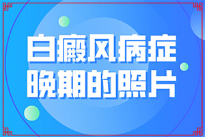 大眼角上面出現(xiàn)白斑是怎么回事,哪些因素會(huì)導(dǎo)致白癜風(fēng)(發(fā)病的因素是)