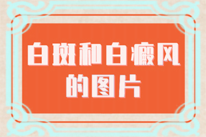 土發(fā)性白點病是什么病有藥治嗎,該如何治療(治白斑怎么得快)