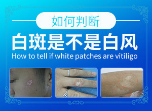 白殿風(fēng)最初圖片,看起來都是啥樣子的(白斑是什么呢)