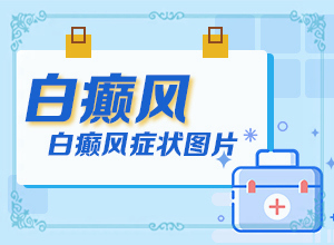 白癲瘋是什么癥狀？[白斑病情有哪些癥狀]手指上白癲風