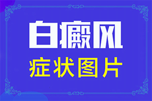 [這有幾種好方法]兒童白點(diǎn)癲風(fēng)可以治好嗎