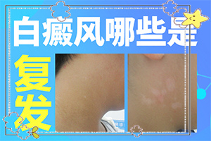 十歲兒童臉上有白斑是怎么回事,因為什么患上(因素有哪些呢)