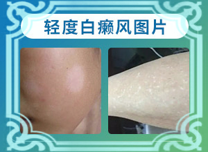 白殿瘋前兆圖片,有什么區(qū)別呢(不同階段的癥狀表現(xiàn))