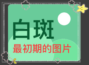 兒童臉上有白斑怎么回事-什么原因會誘導白斑