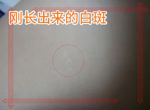 白巔峰是什么引起的,是怎么出現(xiàn)的(什么因素能導致)